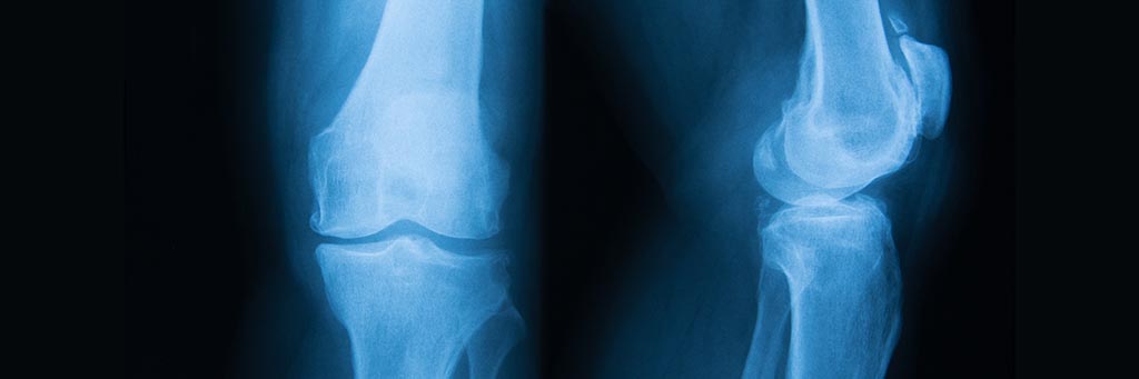 Osteoarthritis X-Ray